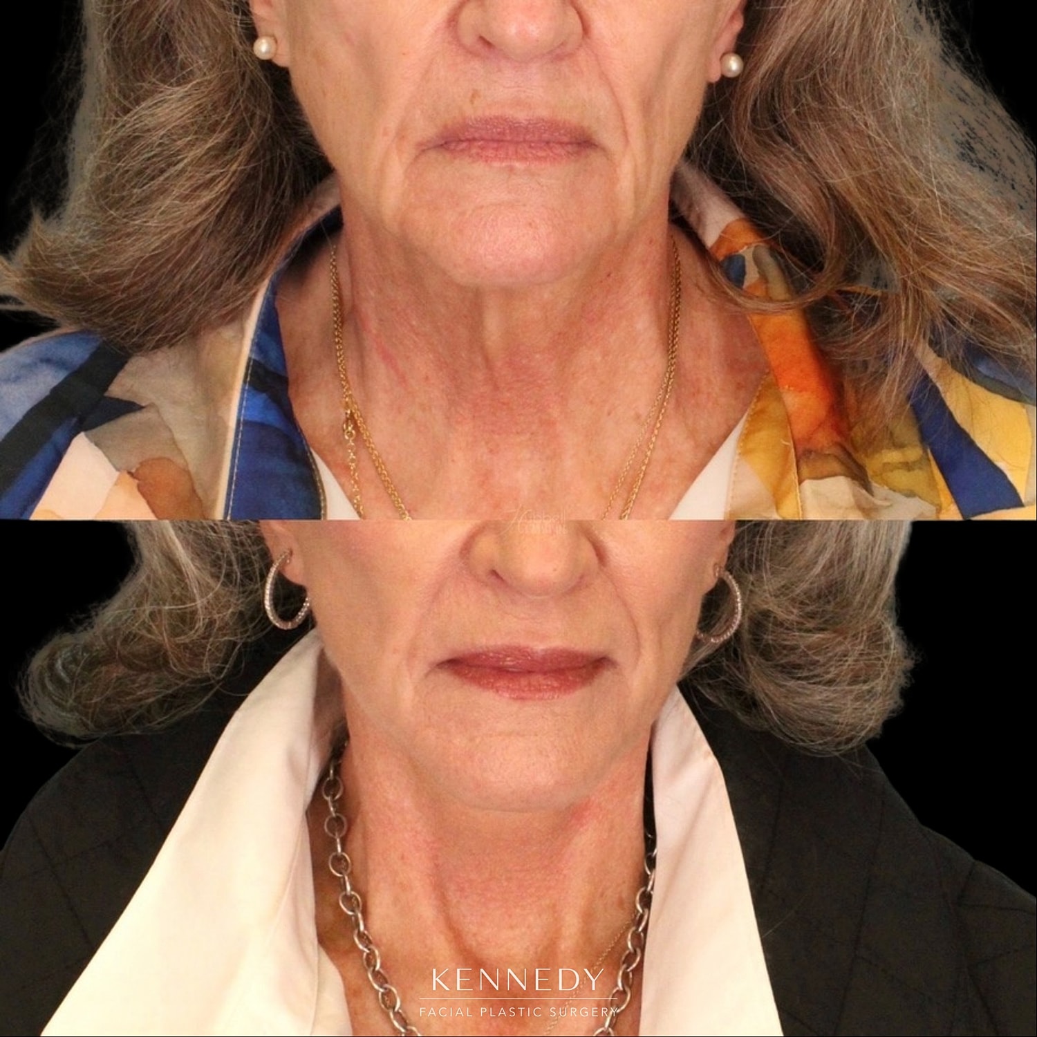 Facelift Before & After