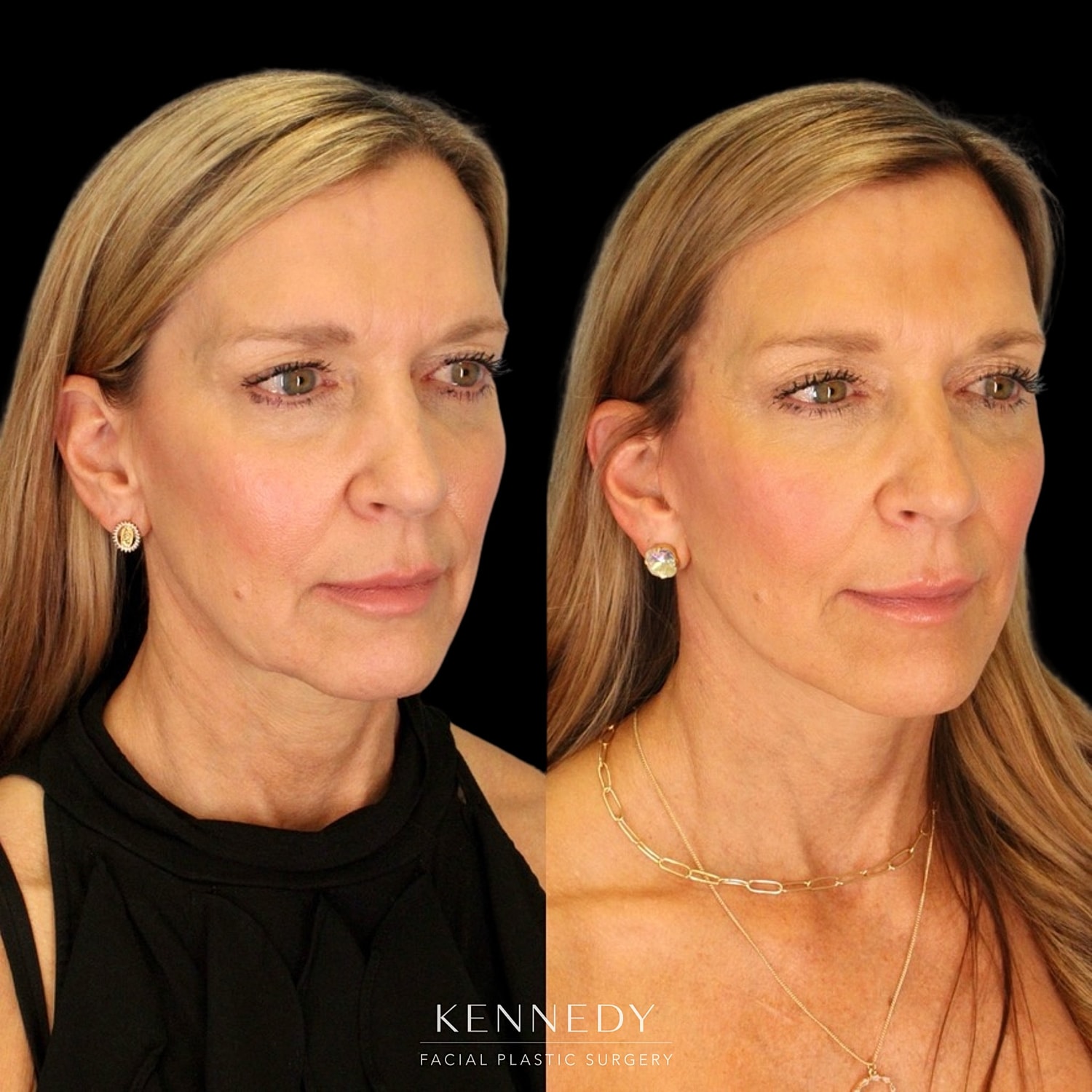 Facelift Before & After