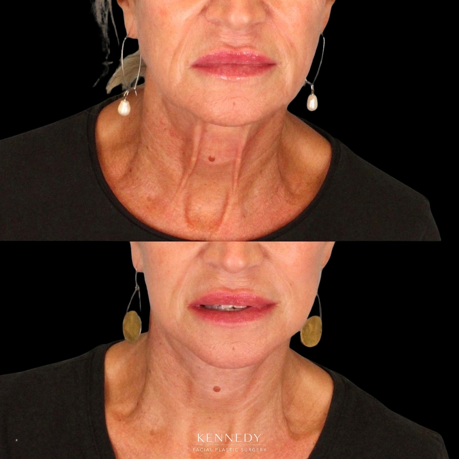 Facelift Before & After