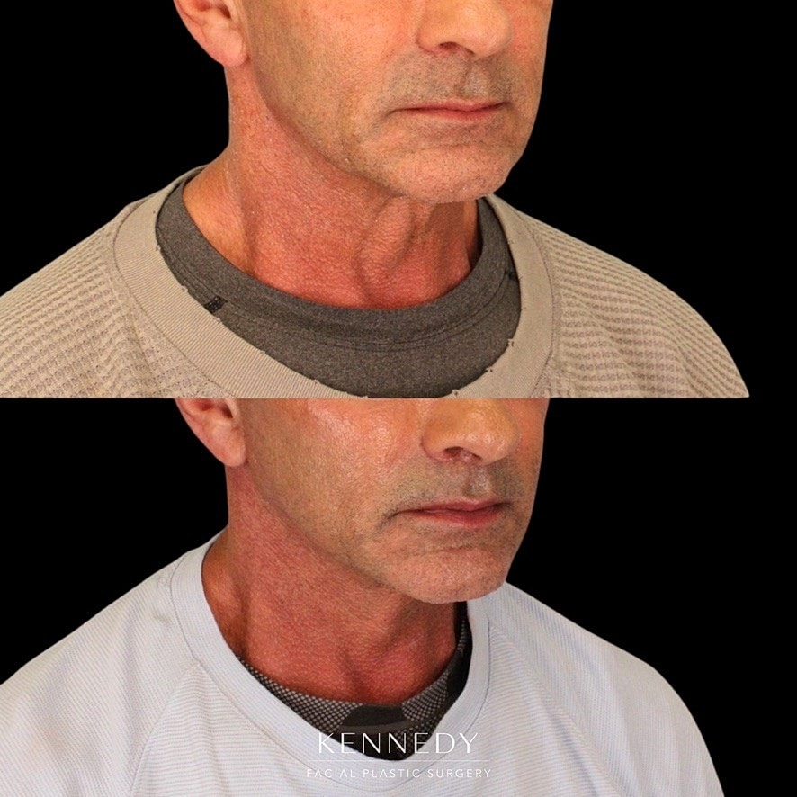 Facelift Before & After