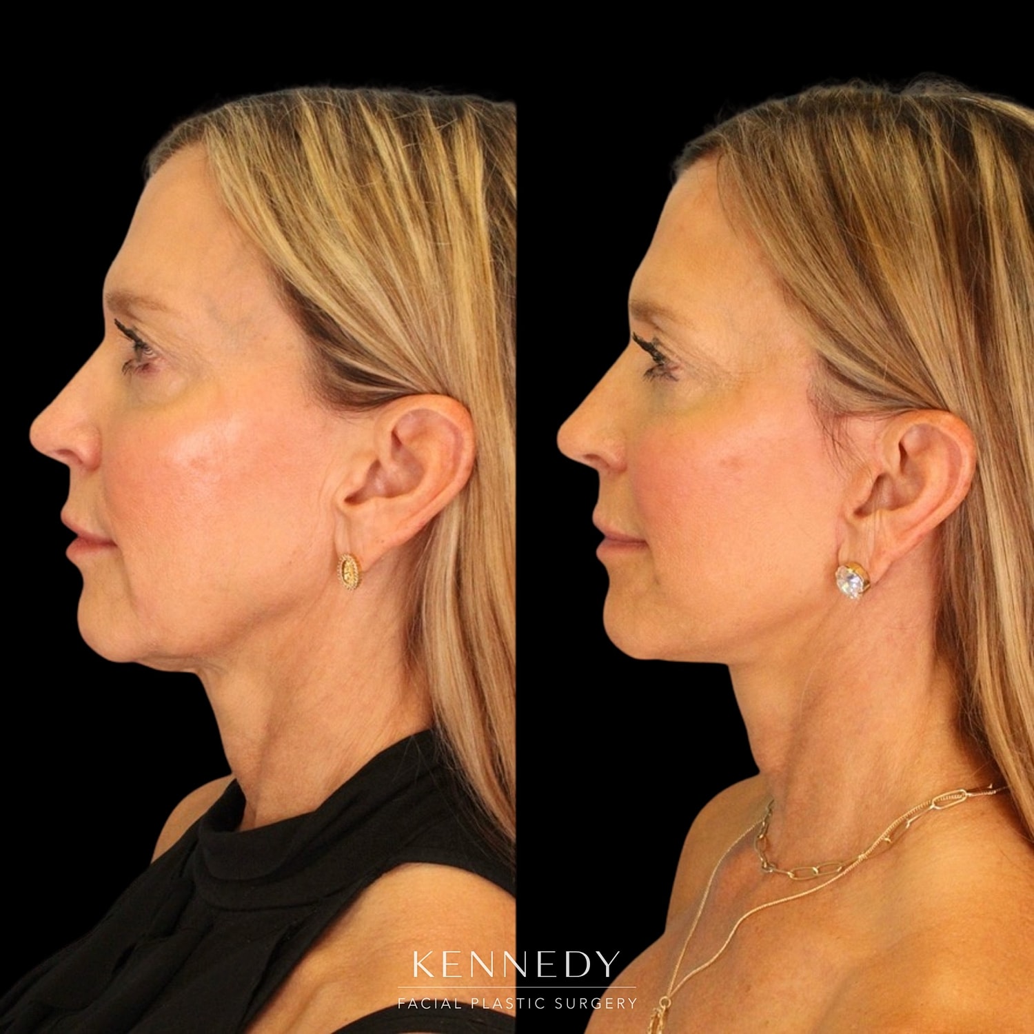 Facelift Before & After