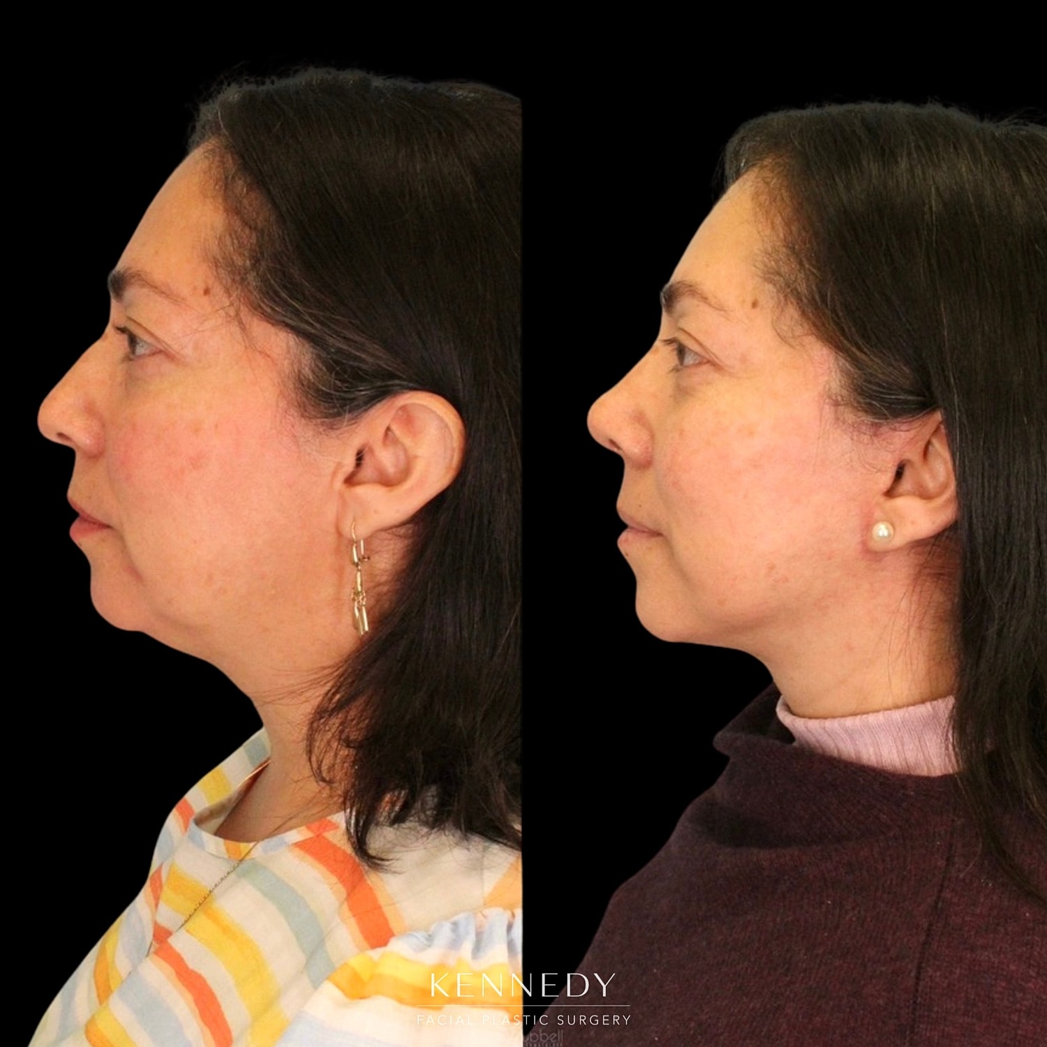 Facelift Before & After