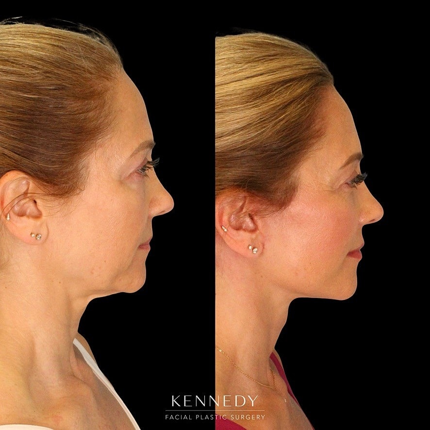 Facelift Before & After