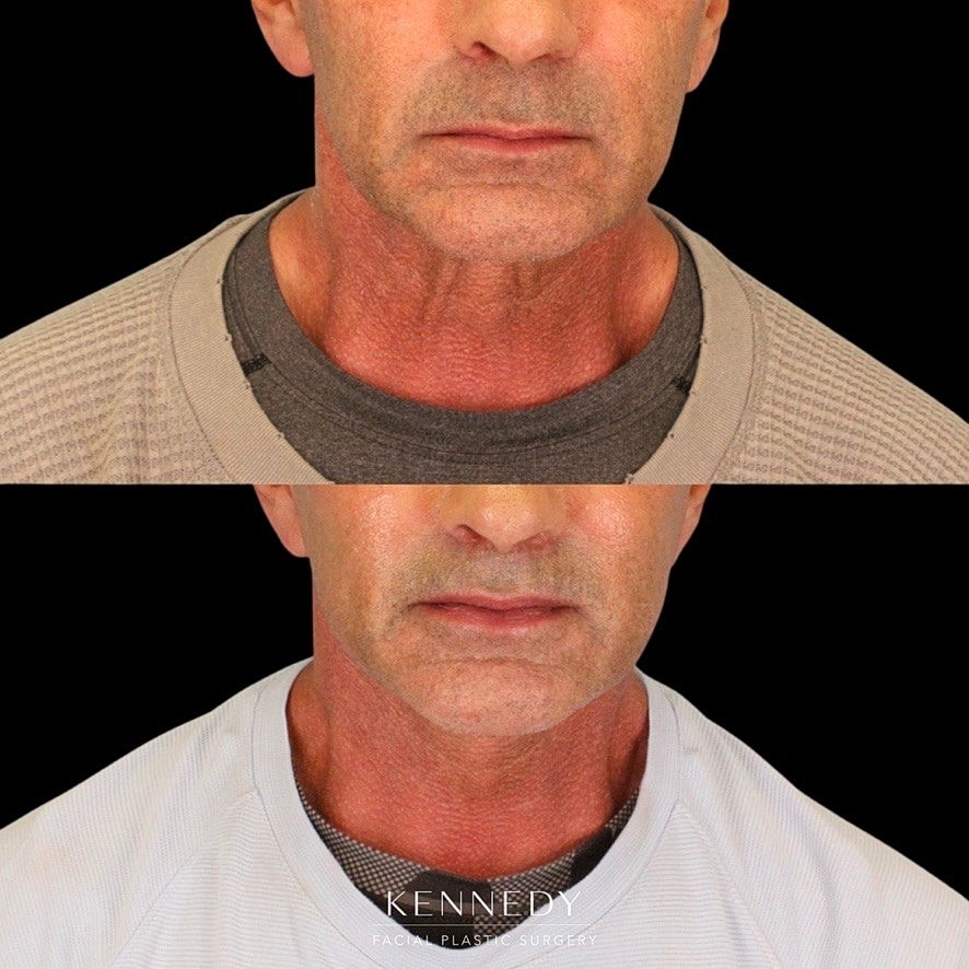 Facelift Before & After