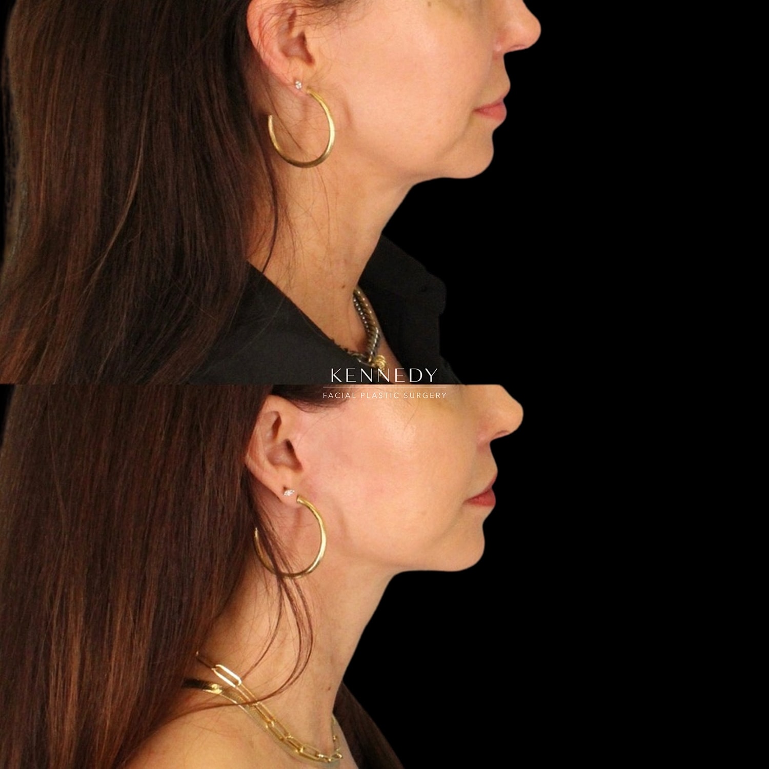 Facelift Before & After