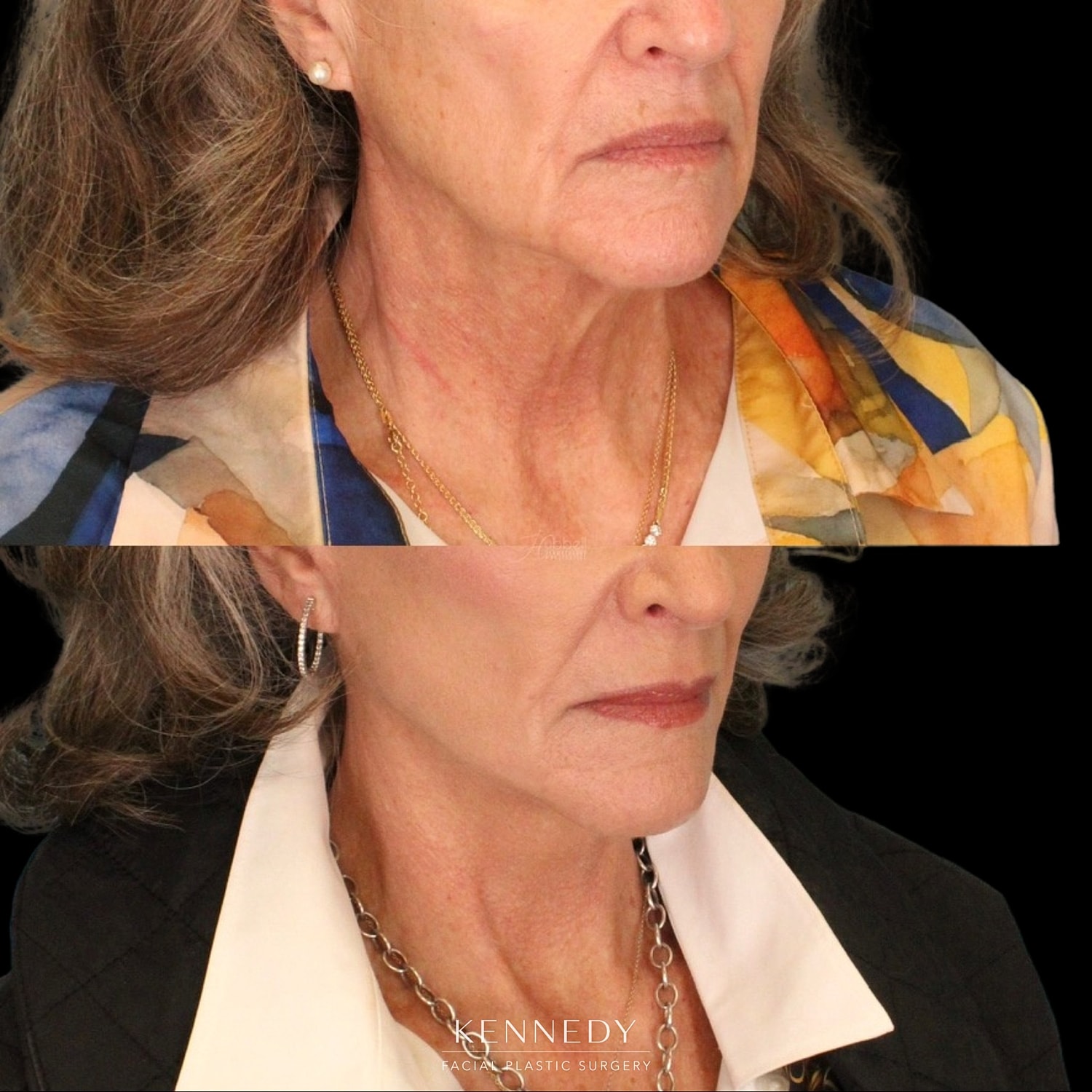 Facelift Before & After