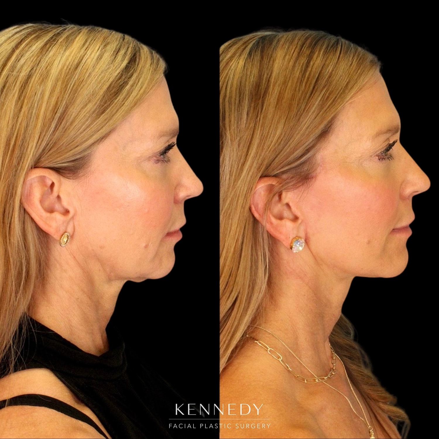 Facelift Before & After