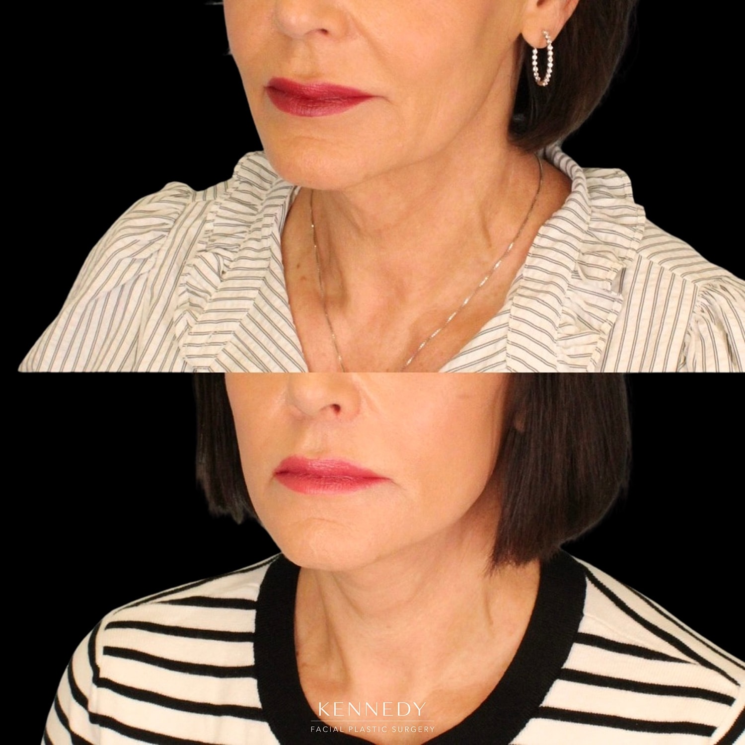 Facelift Before & After