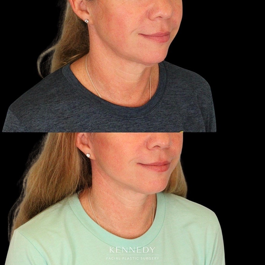 Facelift Before & After