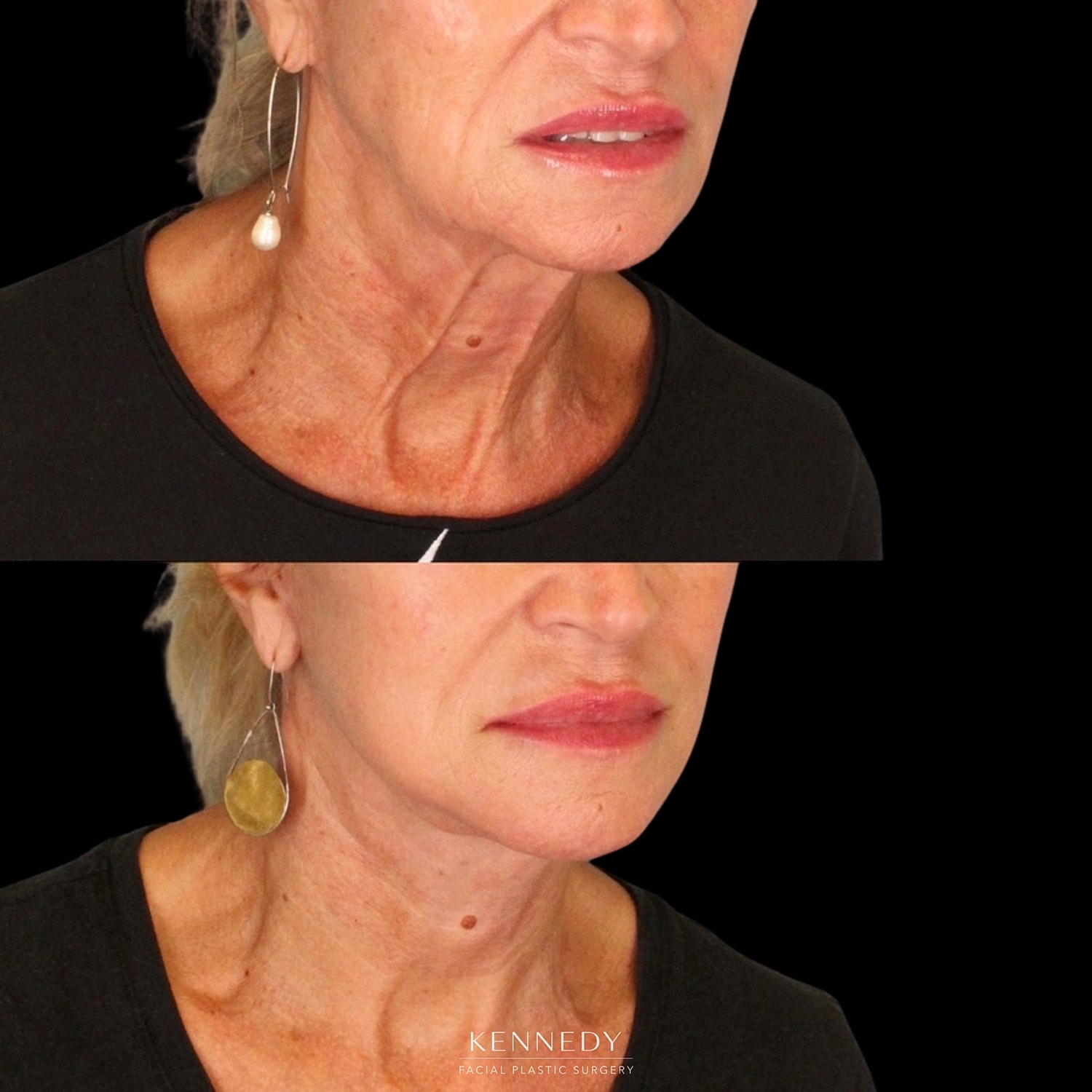 Facelift Before & After