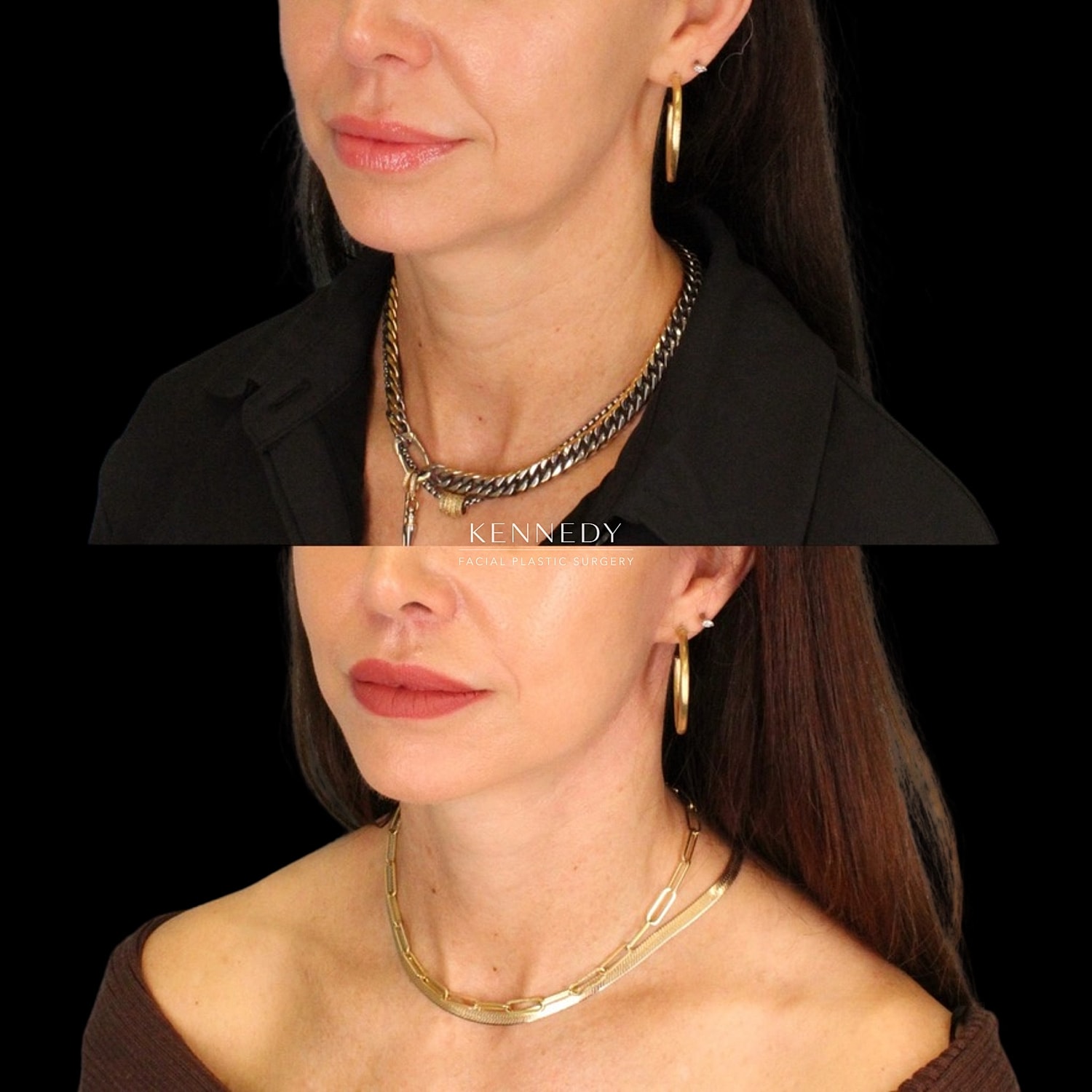 Facelift Before & After