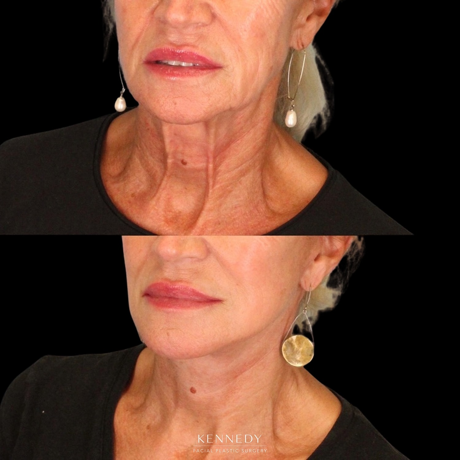 Facelift Before & After