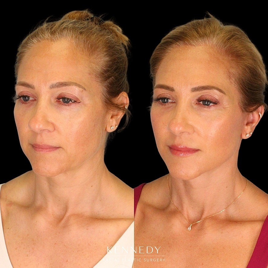 Facelift Before & After