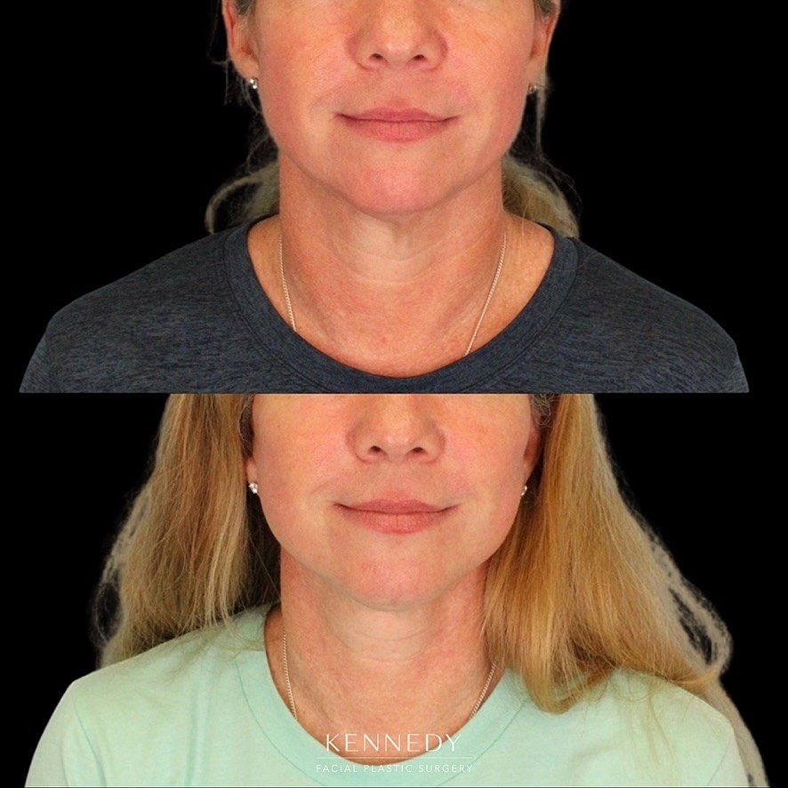 Facelift Before & After