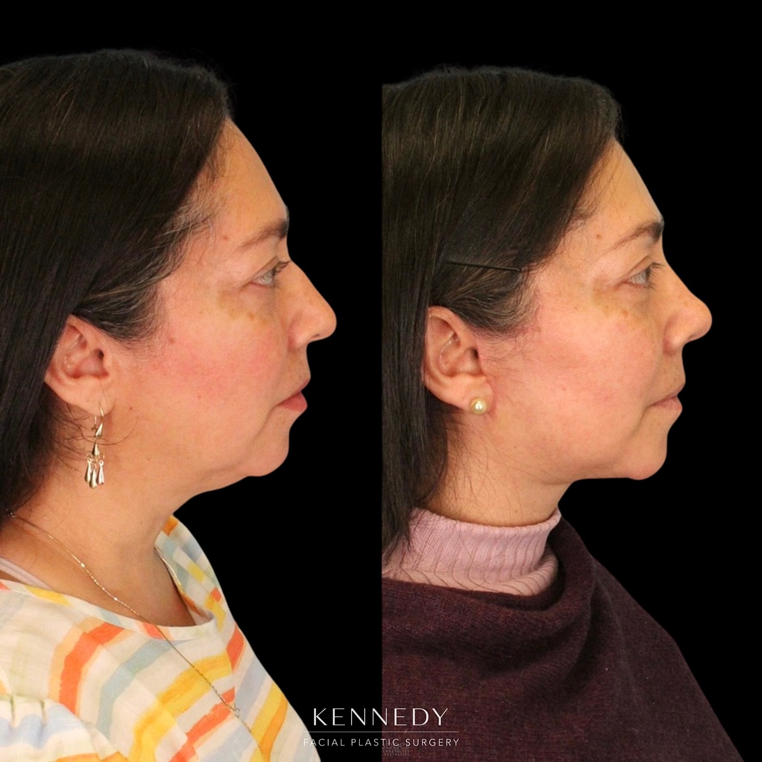 Rhinoplasty Before & After