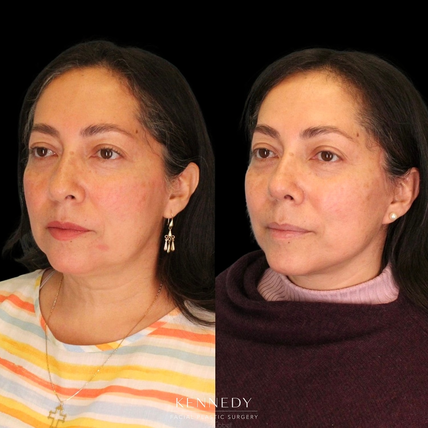 Rhinoplasty Before & After