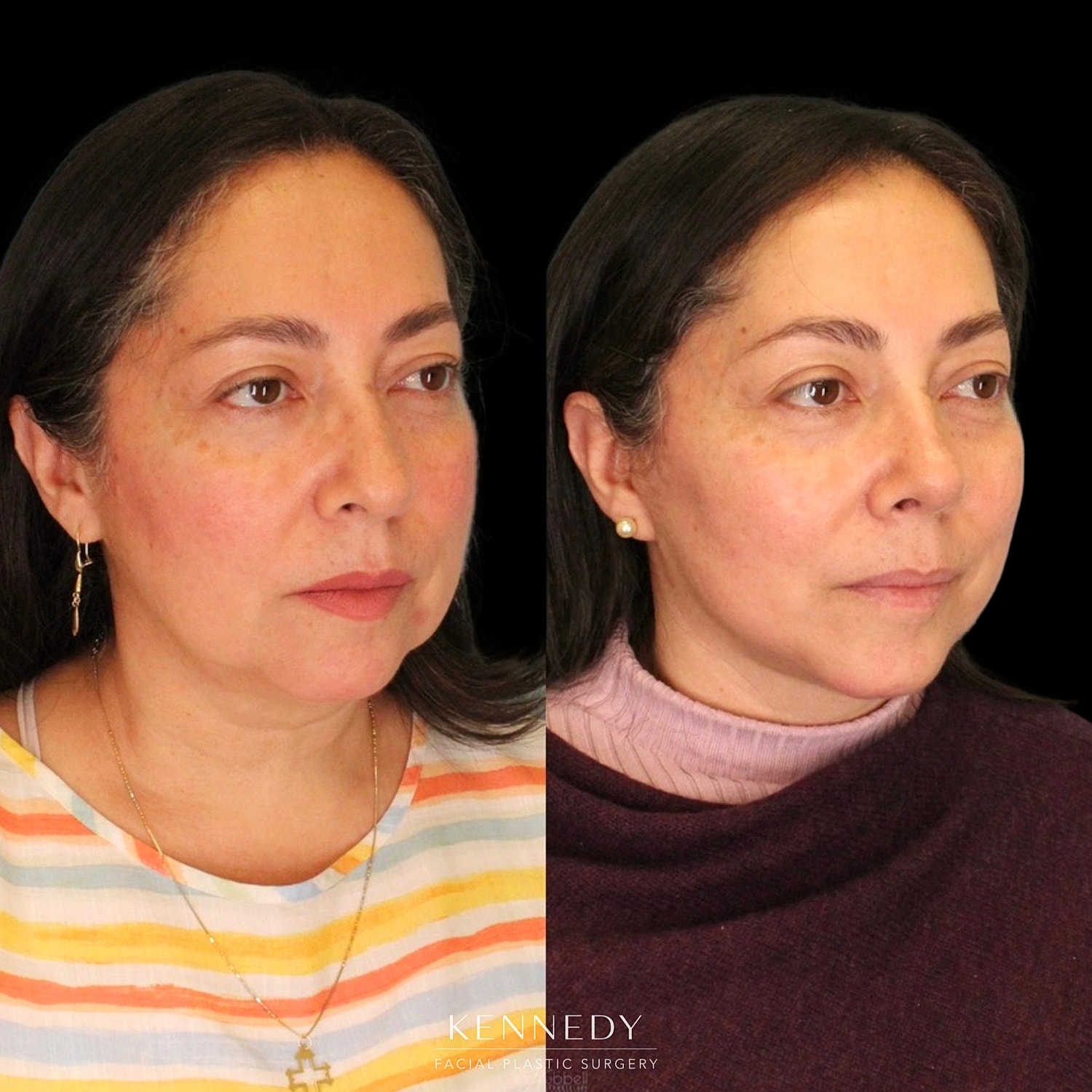 Rhinoplasty Before & After