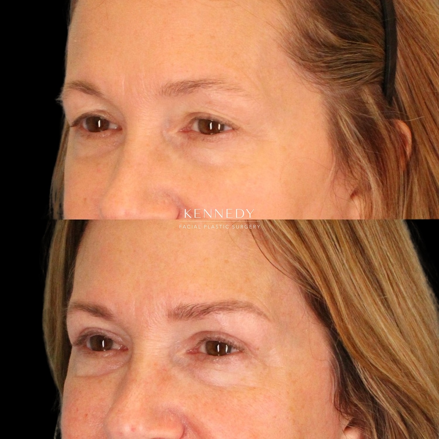 Brow Lift Before & After