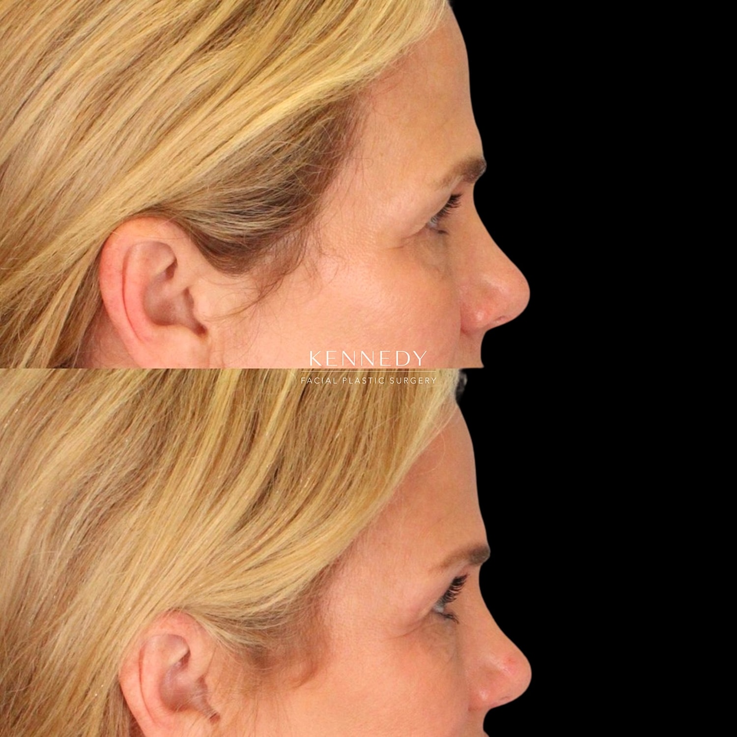 Brow Lift Before & After