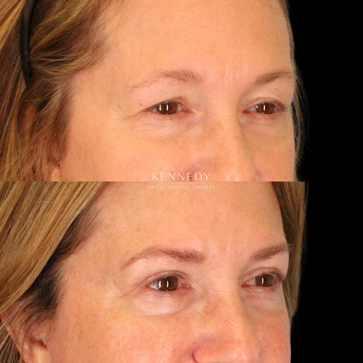 Brow Lift Before & After