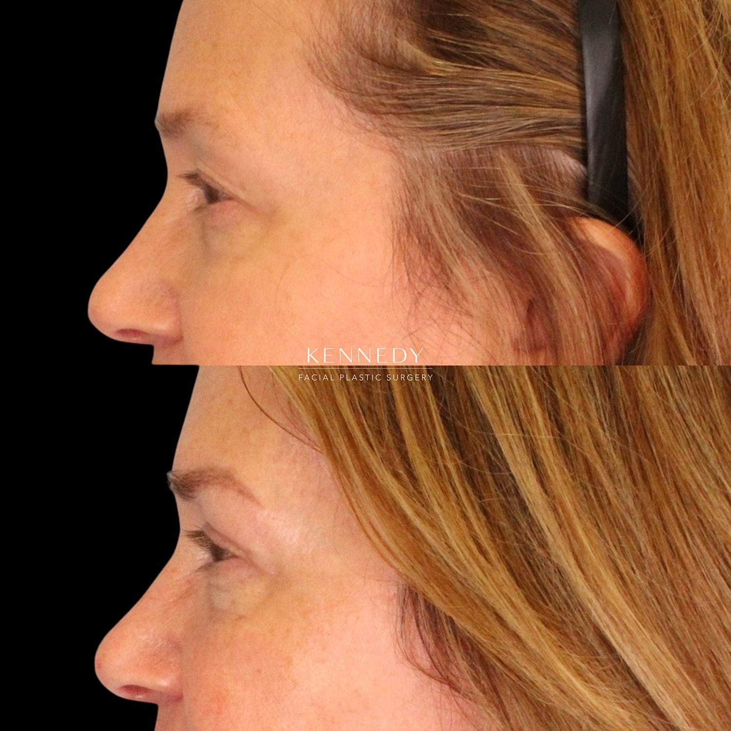 Brow Lift Before & After