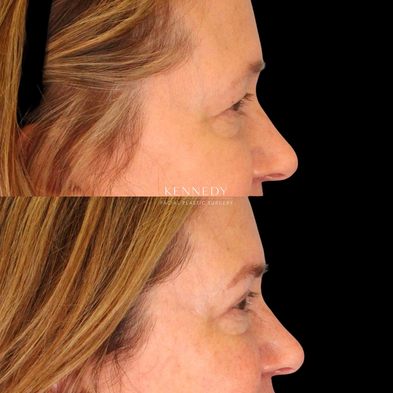 Brow Lift Before & After