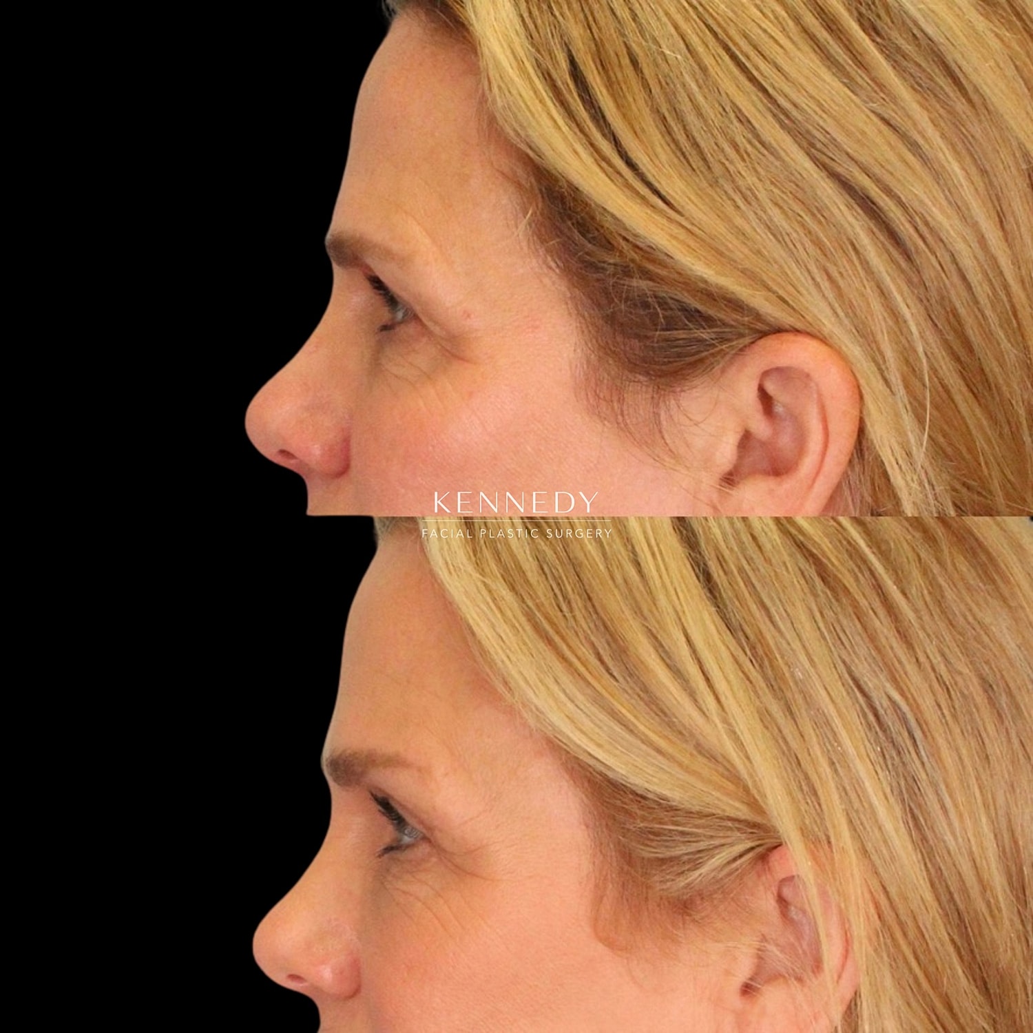 Brow Lift Before & After